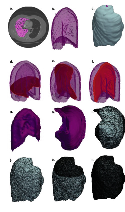 Fig. 2. (a) CT scan used to extract lung segmentation, with the right lung highlighted in magenta. (b) Tetrahedral mesh of the segmented right lung. (c) Synthetic tumour mesh, with the purple point indicating the top of the tumour used for compression simulations. (d)-(f) Cross-section images of the tumour, showing the empty space inside representing the space occupied by the lung. (g)-(h) Core surfaces of the tumour to visualise internal structures. (i) High-resolution sides of the tumour for surface expansion simulations. (j) Downsampled mesh with 5% of the original points for computational efficiency. (k) High-resolution region at the top of the tumour for point compression simulations. (l) Full-resolution tumour mesh.